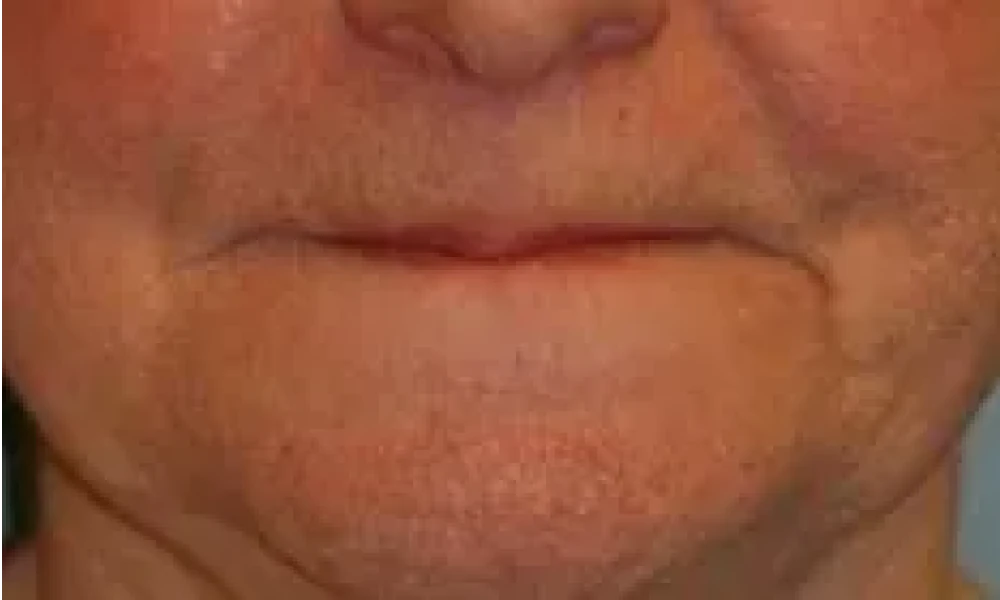 Clinical photo from Kathy's full-arch dental implant case